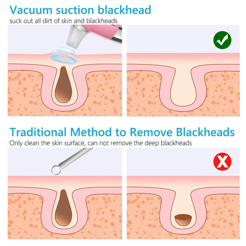 Facial Blackhead Remover Electric Acne Cleaner Device